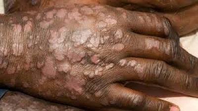 (c) https://www.medicalnewstoday.com/articles/325068